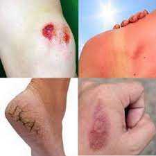 Soin pour brûlures et coups de soleil