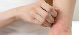 Soin de la peau pour Psoriasis et Eczéma