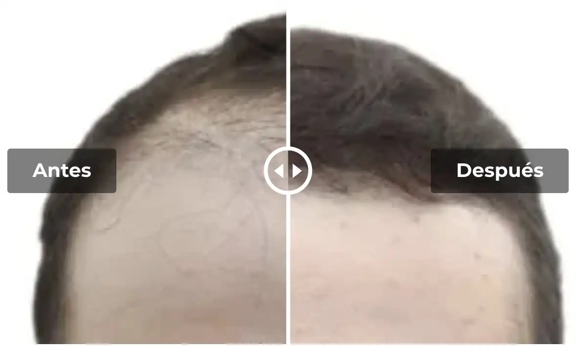 Antes y después de trasplante capilar