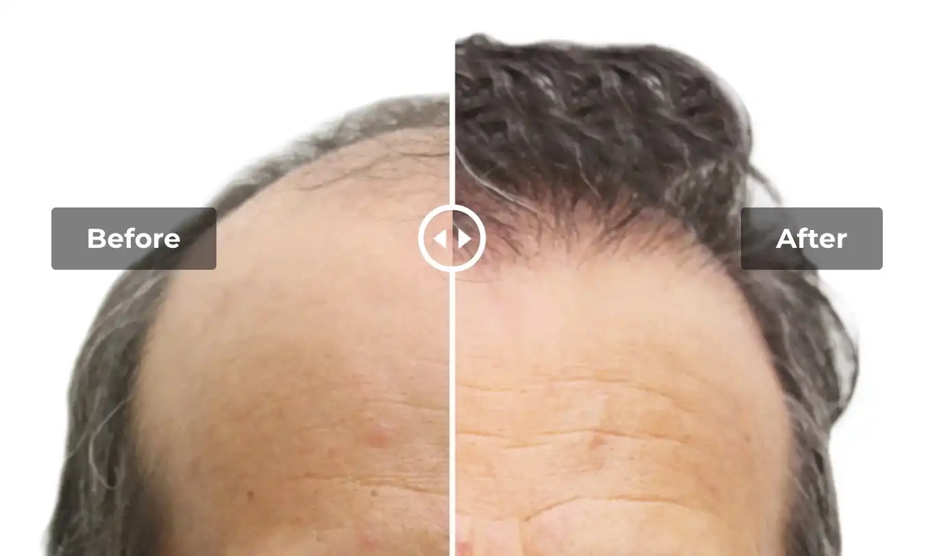 Antes y después de trasplante capilar